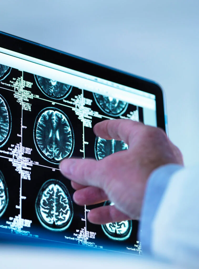 Doctor viewing a series of MRI brain scans on a screen