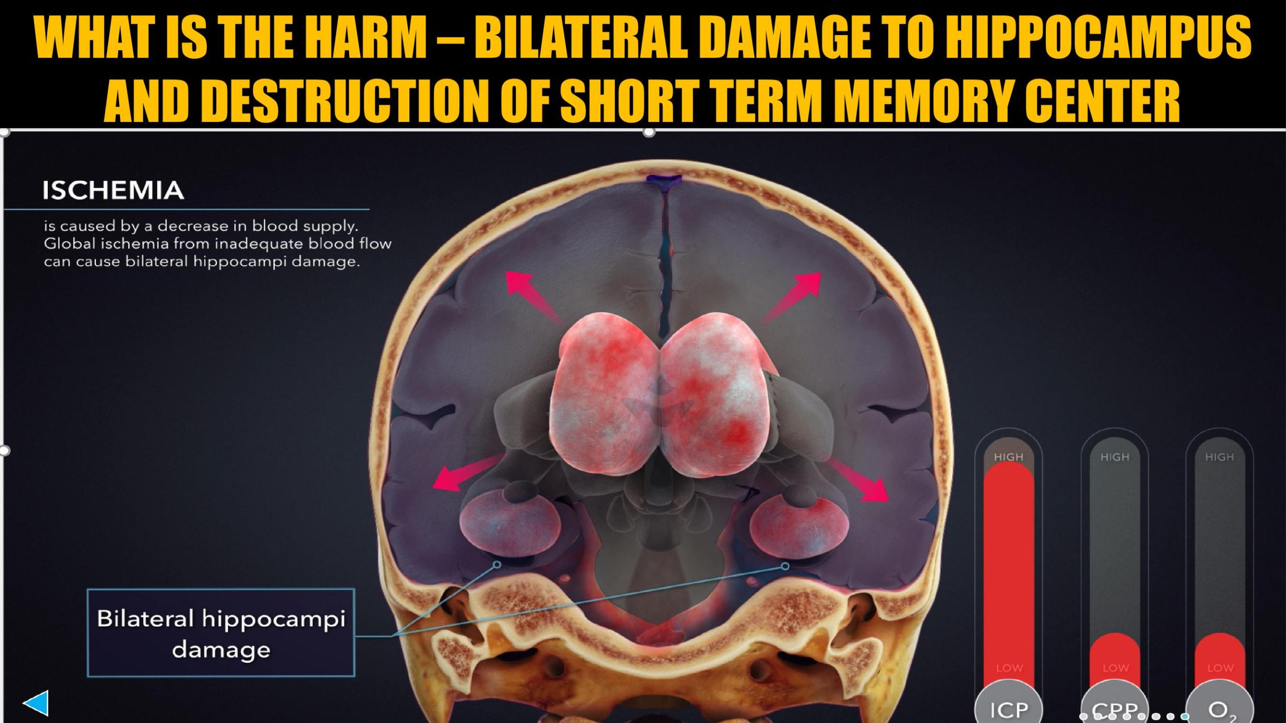 Bilateral hippocampi damage demonstrative in a hotel negligence TBI case in California