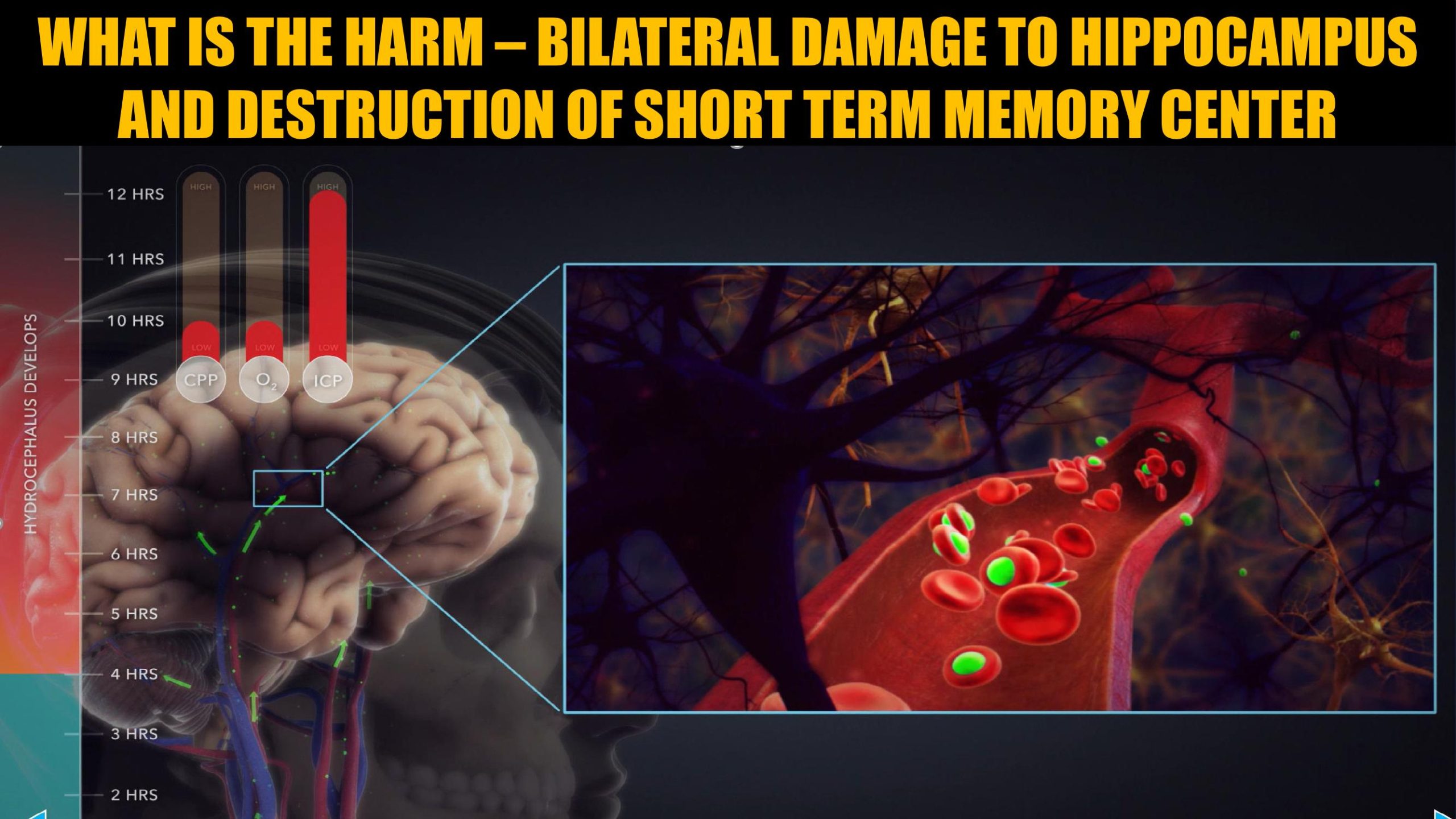 Hydrocephalus timeline demonstrative for a hotel welfare check failure lawsuit
